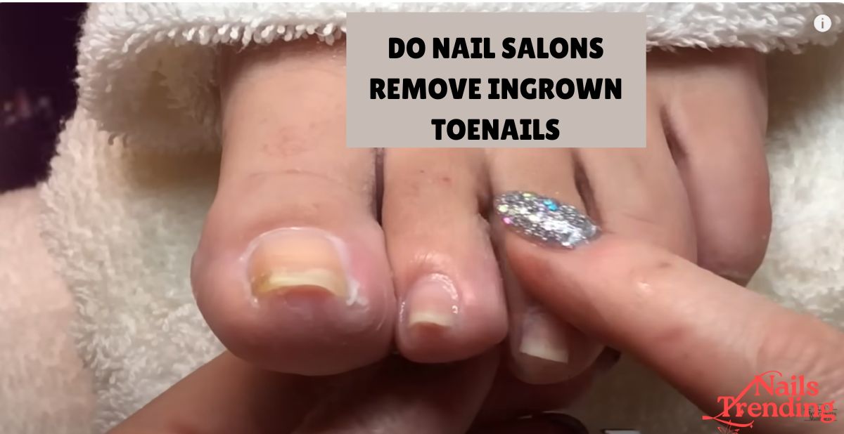 DO NAIL SALONS REMOVE INGROWN TOENAILS