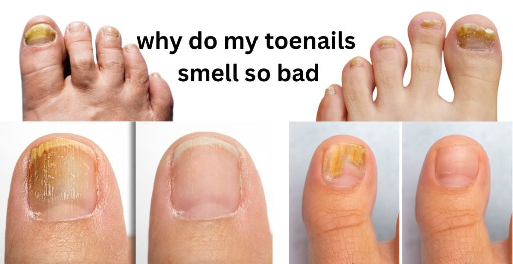 why do my toenails smell so bad