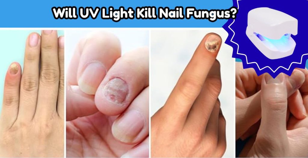 Will UV Light Kill Nail Fungus 