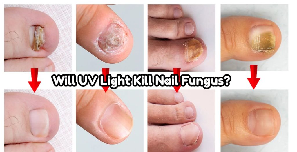 Nail Fungus