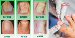 how much is laser treatment for nail fungus