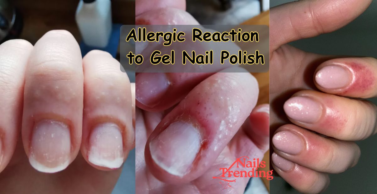 Allergic Reaction to Gel Nail Polish