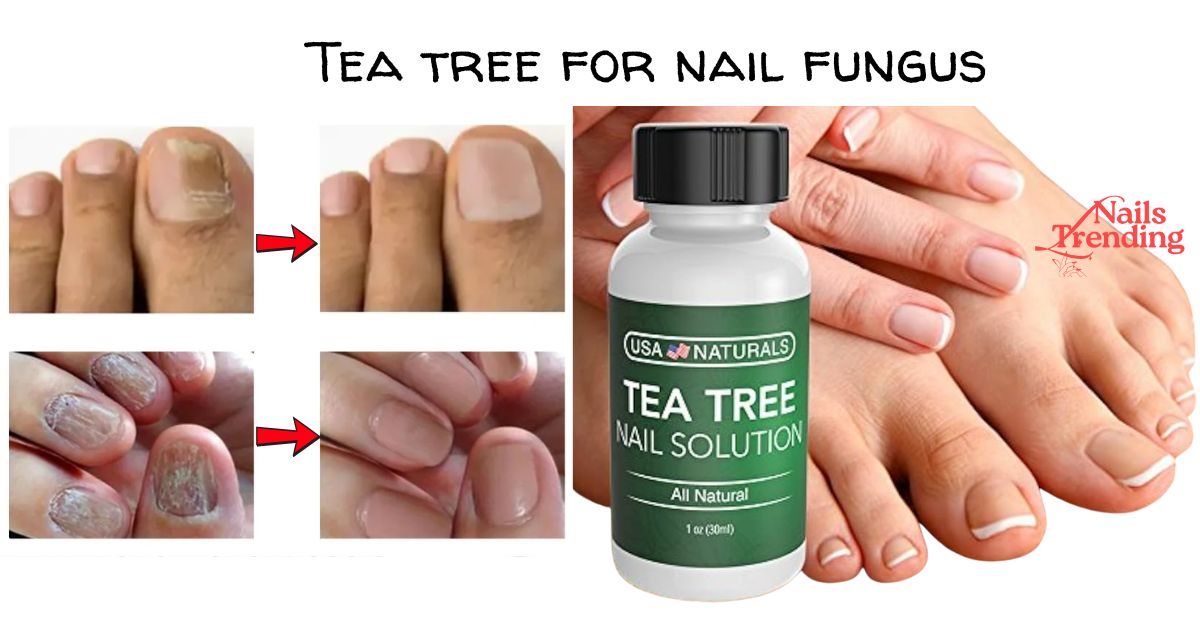Tea tree for nail fungus